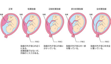 低位胎盤|低置胎盤とは？位置が低い原因は？安静にすれば治。